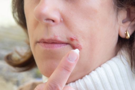 Older woman suffering from herpes on the lips. Treatment of herpes infection and virus with ointment.