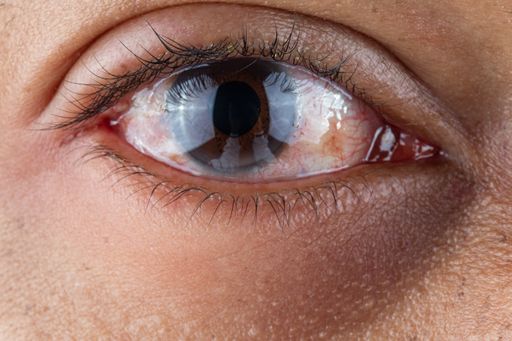 A close-up shot of a red irritated human eye due to conjunctivitis and eyelid herpes