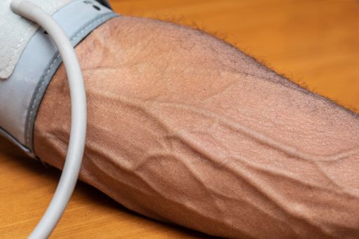 A closeup of bulging veins of a man arm on a health checkup at the doctor's surgery