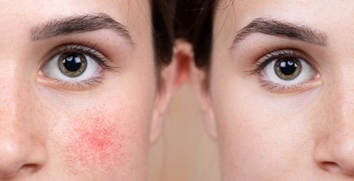 A young Caucasian girl shows the before and after results of intensive light surgery to remove the symptoms of rosacea. Noticeable reduction in cheens