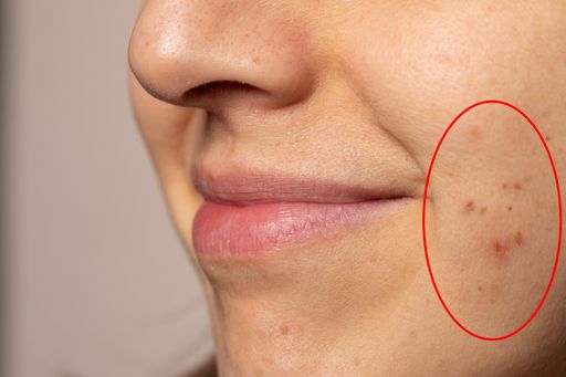 close-up of the face of a white woman with a tendency to acne