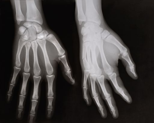 Some X-rays of left hand of an adult man with visible damage