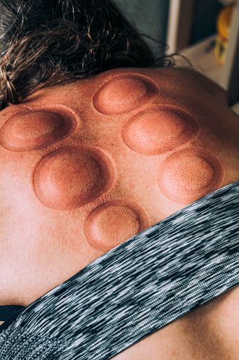 A vertical closeup of the cupping massage technique after removing cups
