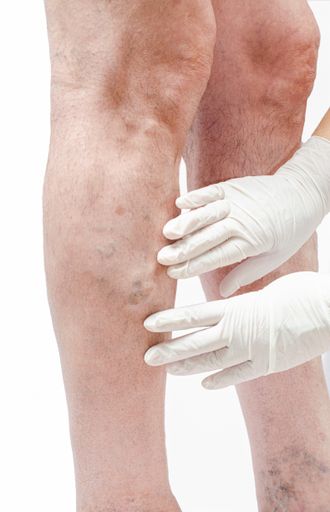 Doctor in white gloves holding man's leg and pointing to varicose veins, deep vein thrombosis, venous injuries on foot. Healthy varicose ulcer.