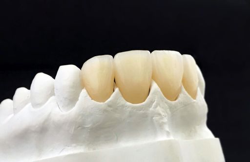 White dental veneers on black background. Zirconia bridge and crown with porcelain in the model. Press ceramic veneers A2 color