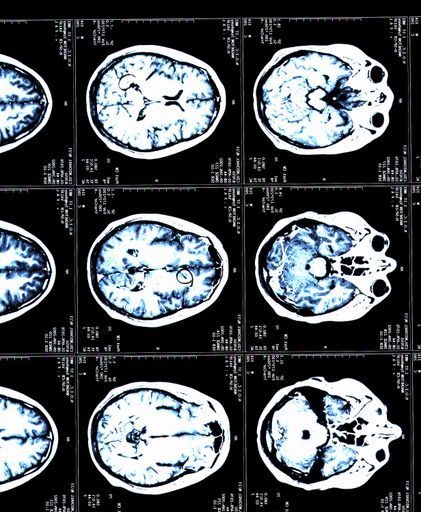 A MRI brain scans of a patient with Multiple Sclerosis