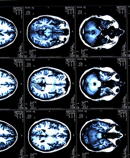 A MRI brain scans of a patient with Multiple Sclerosis