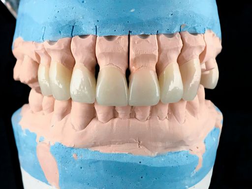 Lower and upper jaw in metal occluder. Dental gypsum model of teeth. Plaster model with all-ceramic bridge restoration.