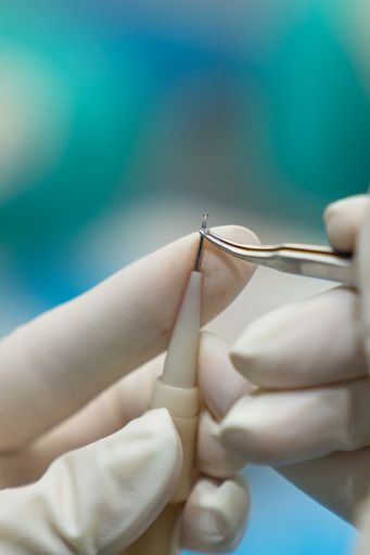 Close up of surgeon's hand placing a follicular unit in the implanter needle for hair transplantation.
