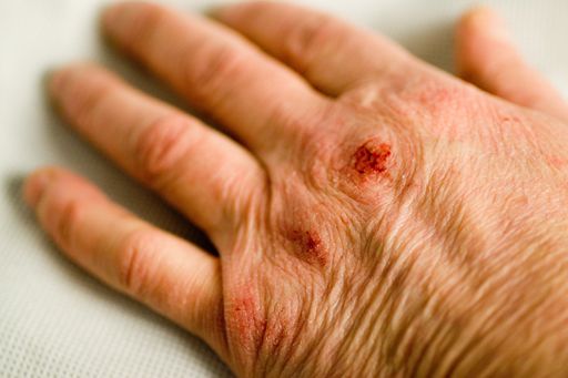 A closeup of a wound on a hand